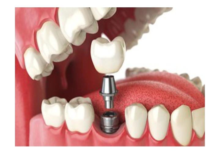 Dental implant with crown