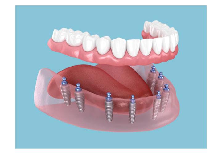 Implant-supported dentures